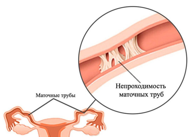 противопоказания