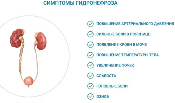 Гидронефроз симптомы
