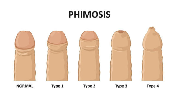 Эффективно ли лечение фимоза мазями