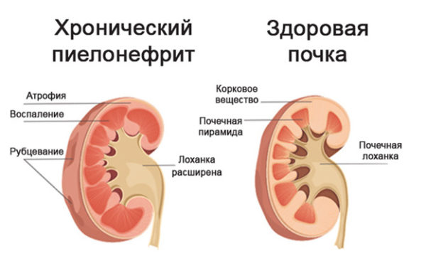 Воспаление почек: причины и симптомы