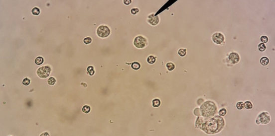 Лейкоциты в моче