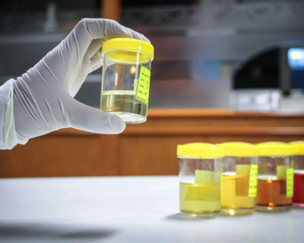 лейкоцитов в моче