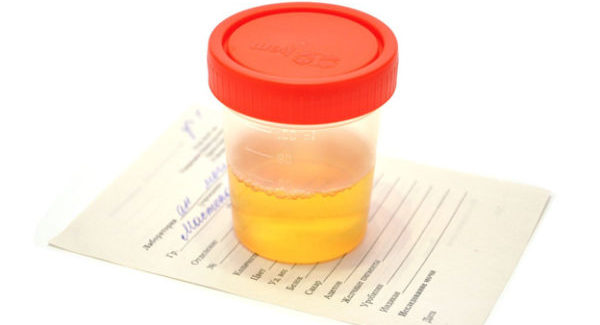 Причины лейкоцитурии