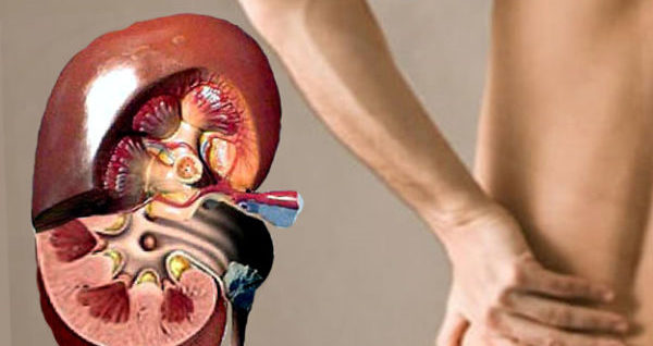 Мочекаменная болезнь