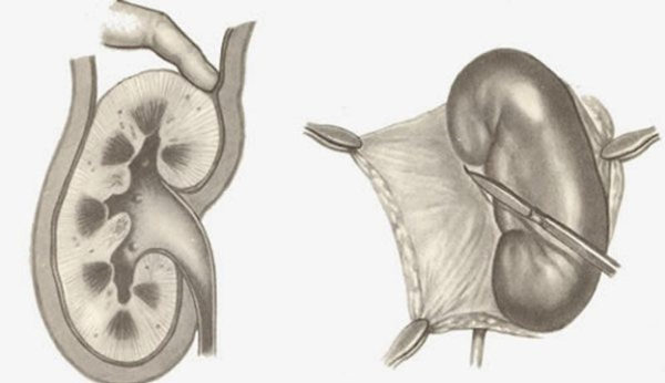 Показания к проведению нефрэктомии