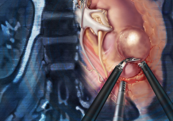 Лапароскопическая