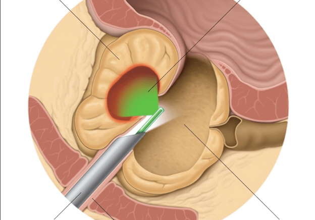 Процедура удаления мочевого пузыря