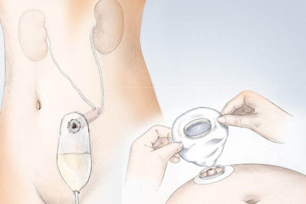 Как удаляют мочевой пузырь и чем заменяют?